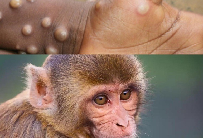 Bệnh đậu mùa khỉ và những điều bạn cần biết