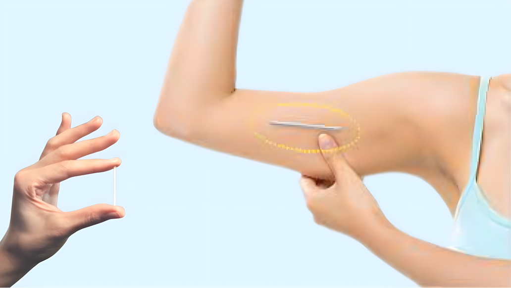 Lợi ích của cấy que tránh thai giải pháp an toàn và hiệu quả