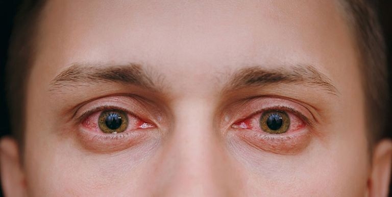 Khuyến Cáo phòng đau mắt đỏ