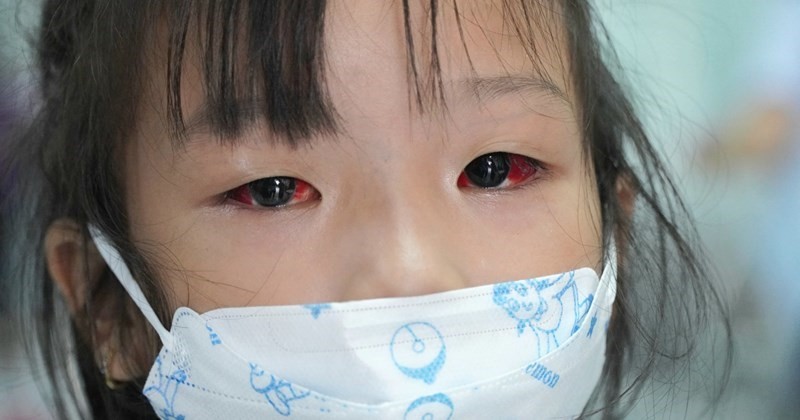 Phòng bệnh bệnh đau mắt đỏ