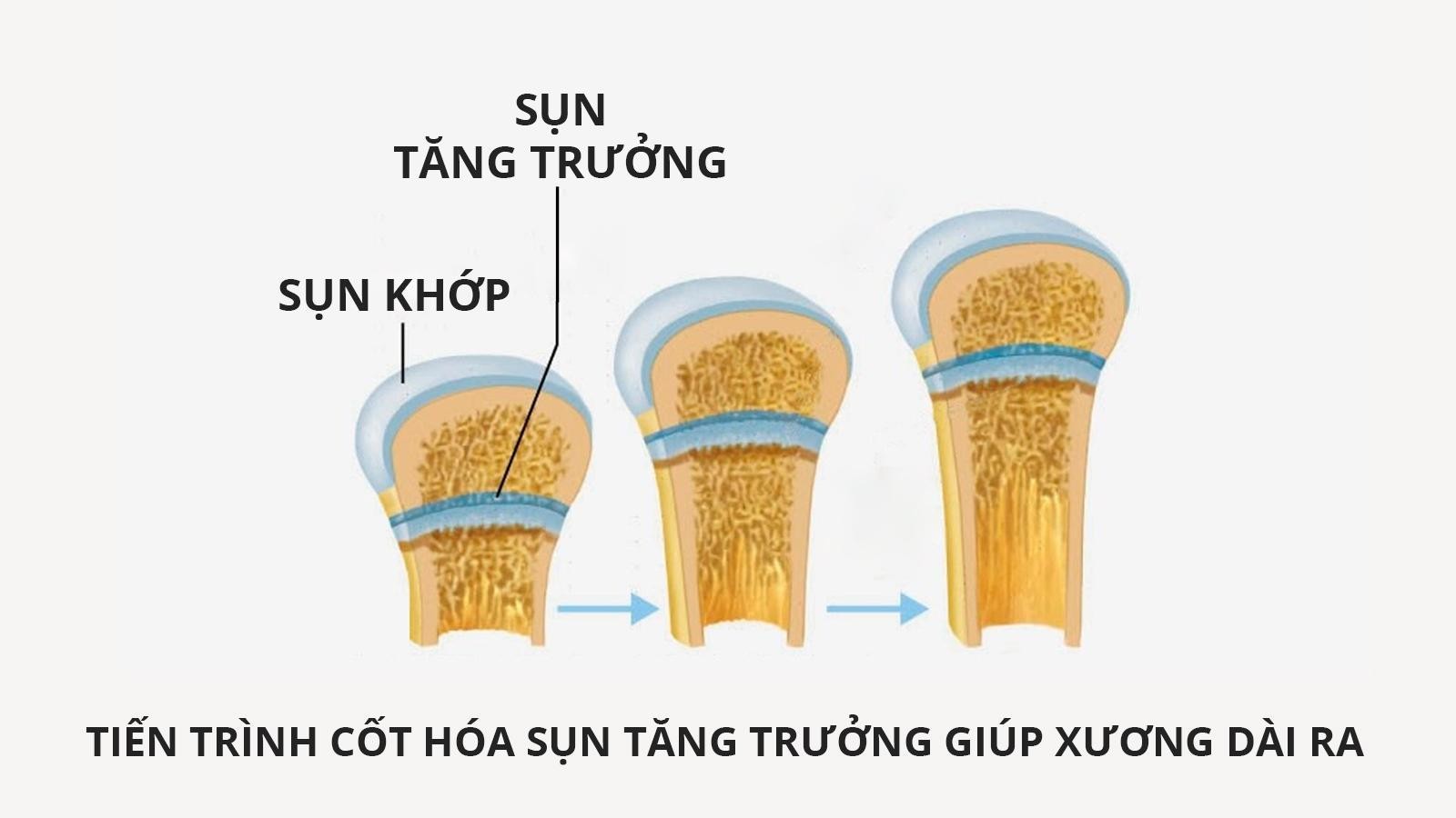 Đau xương tăng trưởng ở trẻ em