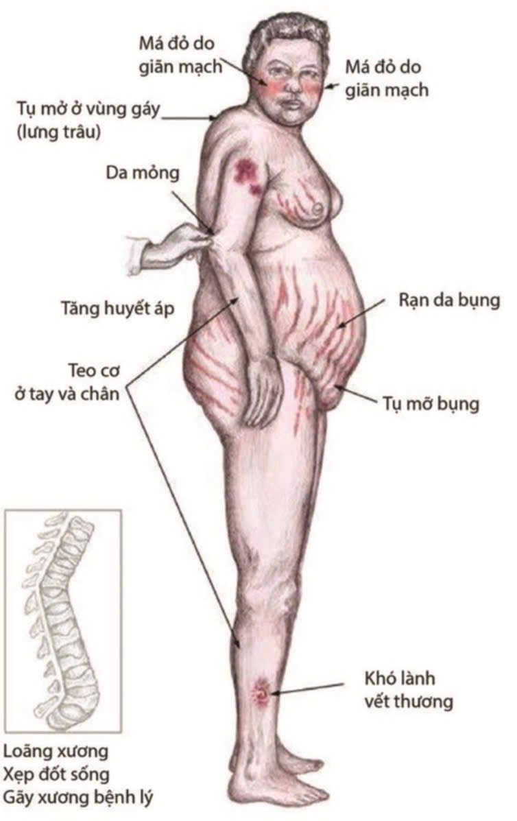 Suy thượng thận do lạm dụng corticoid: Hiểm họa tiềm ẩn