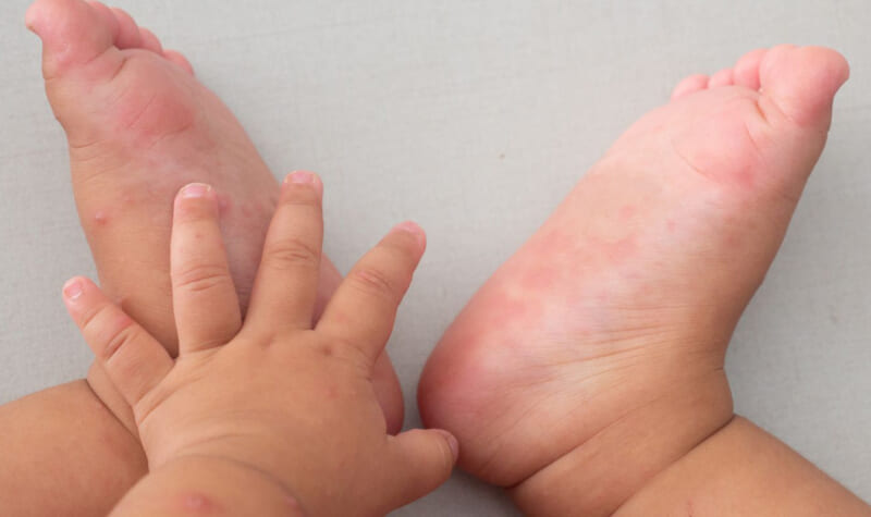 Bệnh tay chân miệng là gì? Cách chăm sóc trẻ bị tay chân miệng như thế nào?