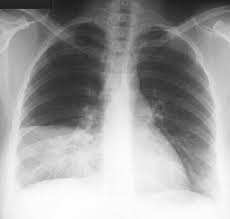 Hướng dẫn chăm sóc bệnh nhân viêm phổi