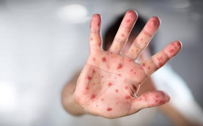 Nguy cơ lây truyền Bệnh Tay Chân Miệng từ người lớn